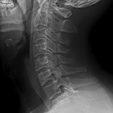 Cervical lateral